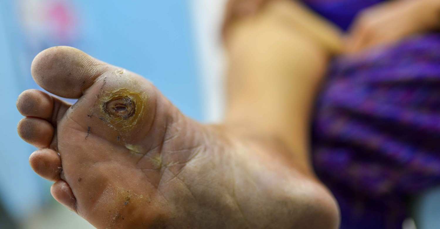 Diabetic Footcare